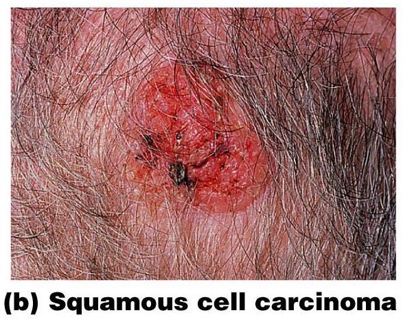 Skin Cancer Types II Squamous cell carcinoma Metastasizes to lymph nodes if not removed