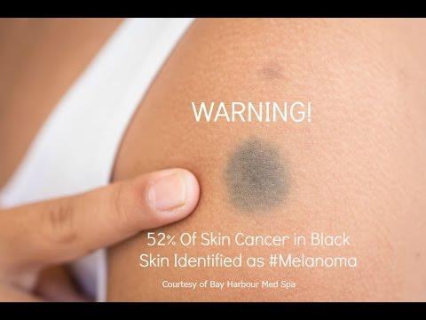 Skin Cancer Types III Malignant melanoma Most deadly of skin cancers Cancer of