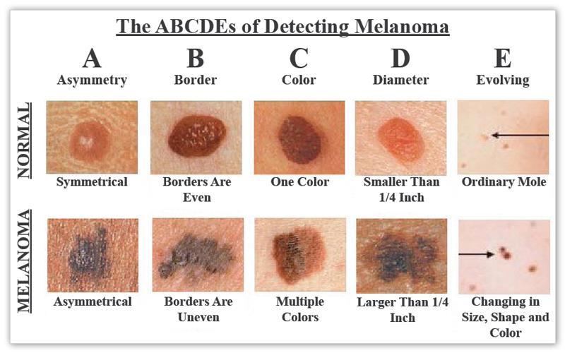 Skin Cancer Types IV