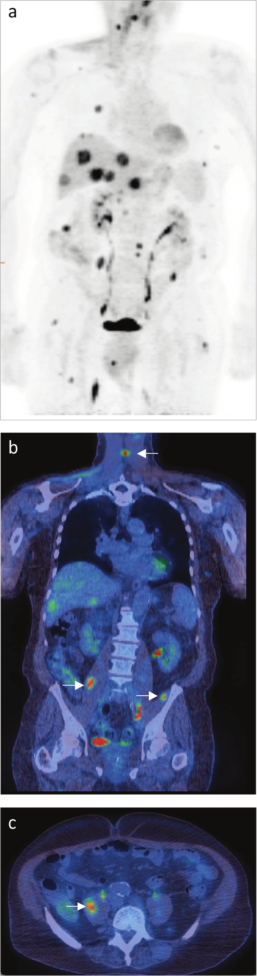 Pancreatic cancer Genitourinary cancers The sensitivity and specificity of 18F-FDGPET/CT is diminished in patients with pancreatic masses when inflammatory markers are raised (false-positives with