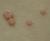 Molluscum Contagiosum Poxvirus Will usually resolve in 6-12 weeks Lesions Small and raised (2-5mm DIA) White, pink, or