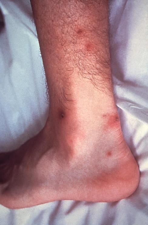 Non-Genital Gonorrhea Disseminated (DGI) (2% of GC infections) Septic emboli cause polyarthritis & dermatitis + fever Severity variable Usually no urogenital symptoms Diagnosis joint aspiration (gram