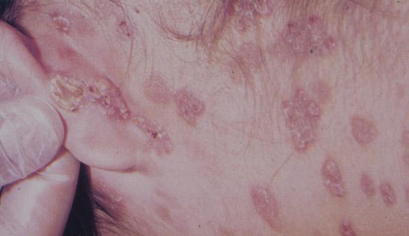 Secondary Syphilis Rash: Anything except