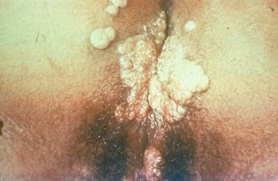 (HPV) ID 11257 S Lindsley 1971 CDC