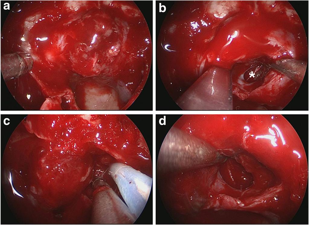 Shou et al. BMC Neurology (2016) 16:247 Page 4 of 8 Fig. 2 a The sellar floor was open to expose the tumor. b The tumor invading left cavernous sinus was removed.