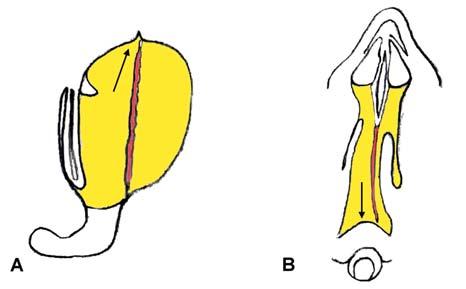 184 Ligia Tataranu et al Endoscopic endonasal transsphenoidal approach Figure 2 Schematic drawings of the nasal cavity depict coronal (A) and axial views (B) of a paraseptal approach to the sella.