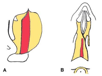 5 cm in diameter) Figure3 Schematic drawings of the nasal cavity depict coronal (A) and axial views (B) of a deeptransseptal approach to the sella Table 1 Alternative surgical techniques of the