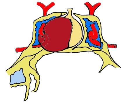 Romanian Neurosurgery (2010) XVII 2: 182 191 187 necessary to perform an extended anterior sphenoidotomy (Figure 9).