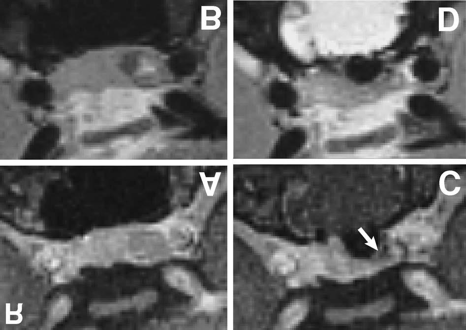 The adenoma is evident as an area of low intensity on the contrast-enhanced volumetric interpolated brain examination image (A), and as an area of isointensity on the T 2 -weighted image (B).