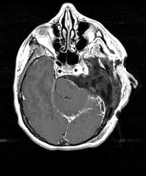 - Craniotomy although still the preferred approach to most, especially large, frontal tumors carries defined