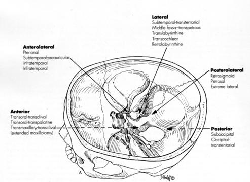 Meningioma 1985 Craniotomy and