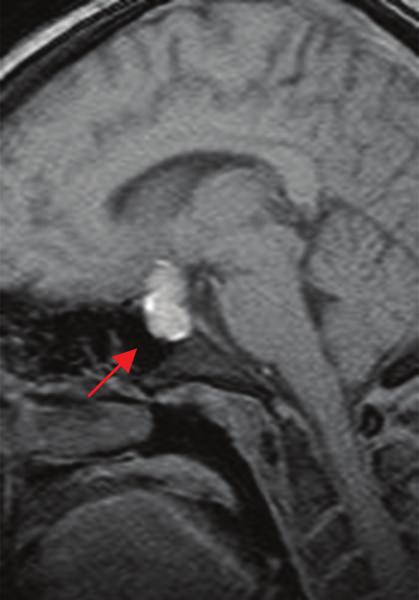 2 Surgery Research and Practice Figure 1: Sagittal T1 MRI of brain without contrast shows area of hyperintensity within the sella and suprasellar regions (red arrow).