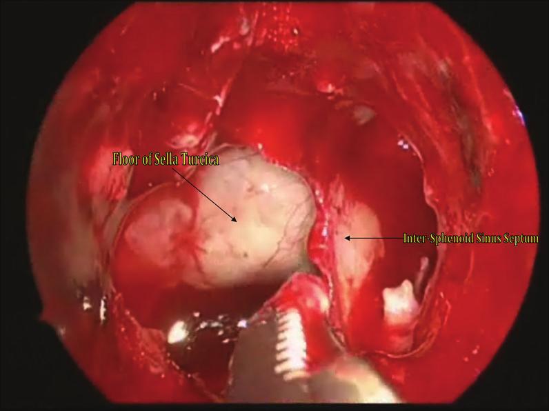 Figure 2: Intraoperative view through the operative endoscope revealing the intersinus septum within the sphenoid sinus and the floor of the sella turcica. vision in the right eye.