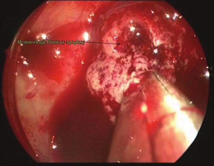 Given the significant, acute, neurologic deficit noted upon the examination, the decision was made to offer the patient minimally invasive surgical intervention.
