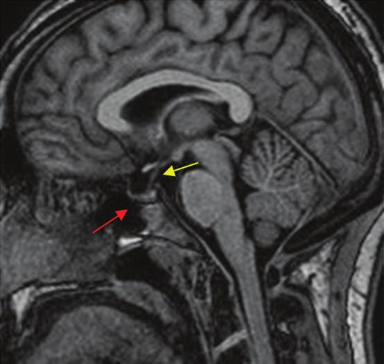 Surgery Research and Practice 3 Figure 4: Postoperative sagittal T1 MRI of brain without contrast shows resolution of the prior areas of hyperintensity within the sella turcica (red arrow).