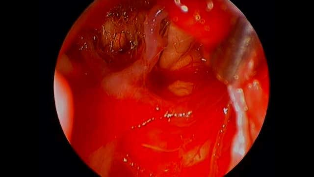 expansion Drain Cyst