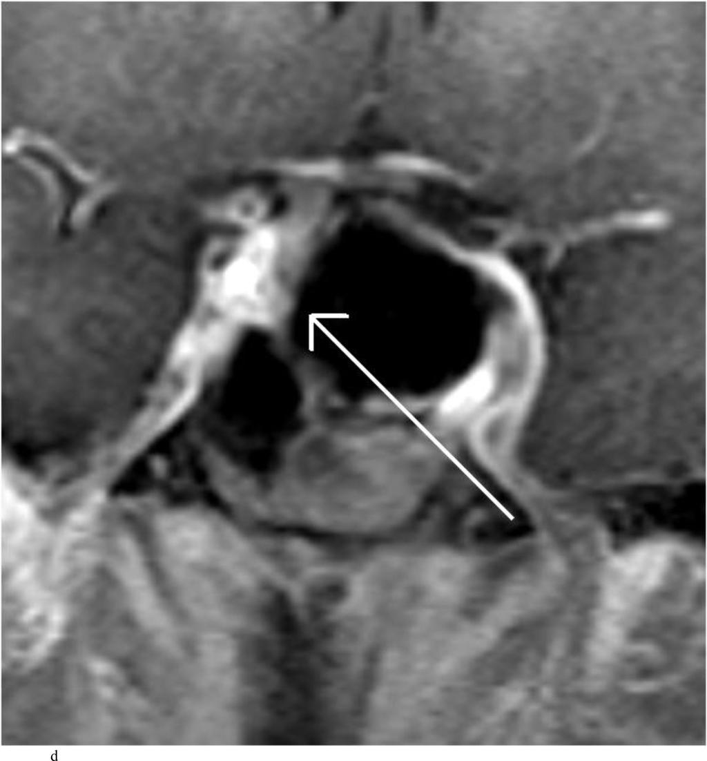 Zaidi et al. Page 25 Fig. 4. Case 10. This patient presented with a recurrent nonfunctioning adenoma and visual loss.