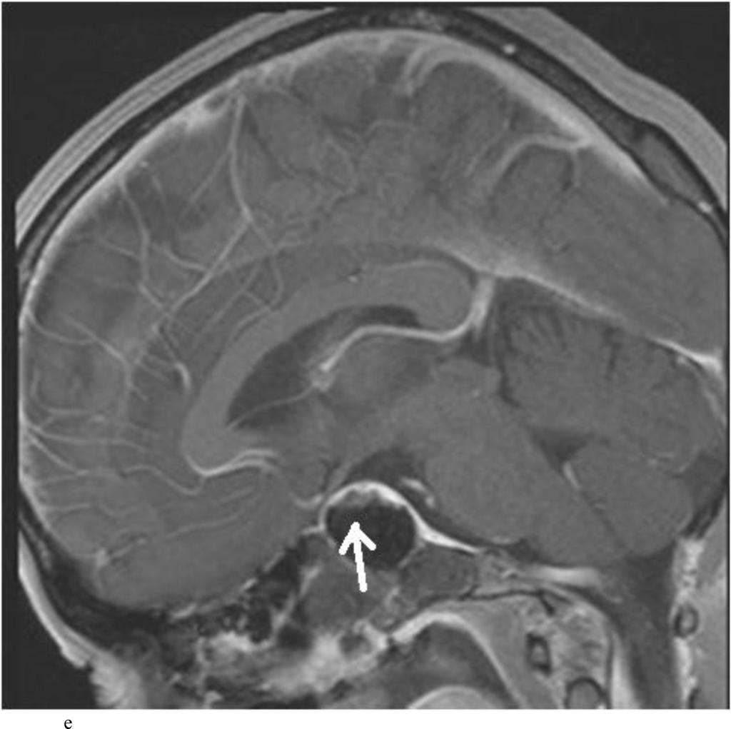 Zaidi et al. Page 31 Fig. 5. Case 12. This patient presented with visual loss and was found to have a nonfunctioning adenoma.