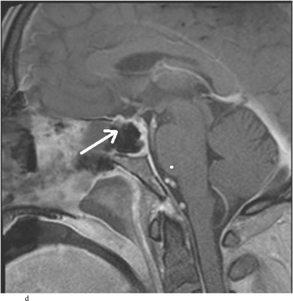 Zaidi et al. Page 35 Fig. 6. Case 15. This patient presented with headaches and visual loss. A and B: Preoperative coronal (A) and sagittal (B) T1-weighted MR images demonstrating a macroadenoma.