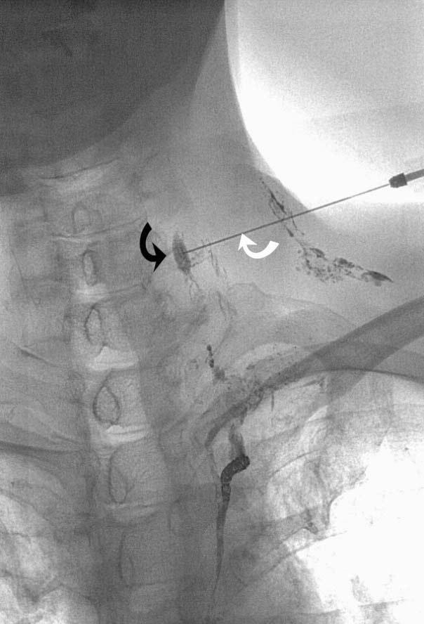 (d,e) Twenty-two days after the first procedure, a second therapeutic lymphangiography was performed using a left cervical lymph node (d, curved black arrow) and