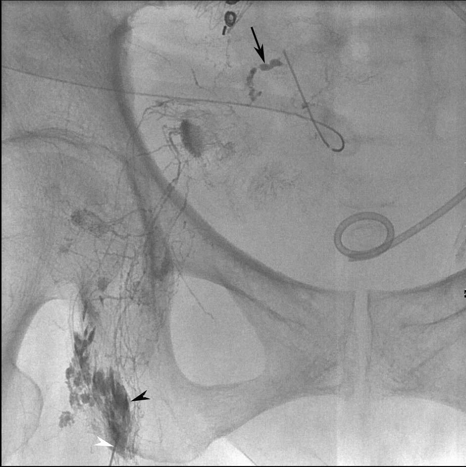 62 2a 2b Fig. 2. A 63-year-old woman underwent ileocecal resection for a small intestinal perforation with peritoneal drainage tube placement.