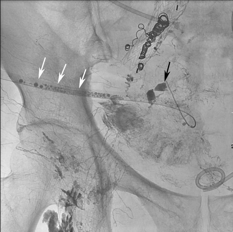 demonstrates lipiodol leaking into the pelvis (a and b, black arrow) and lipiodol within the drainage tube (b, white arrows). Fig. 3.