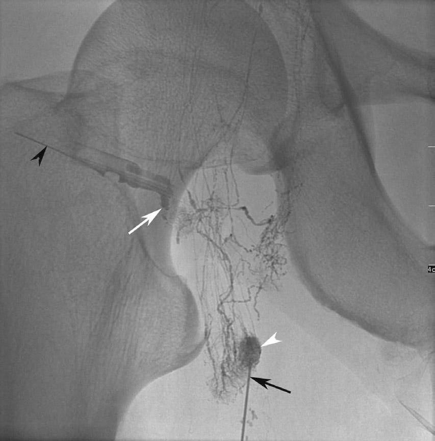 A therapeutic lymphangiography using lipiodol and puncture of a right inguinal node was performed.