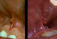 Also noted in some patients along the upper lip near the vermilion are clusters of yellow-white submucosal pinhead glands that are called Fordyce granules.