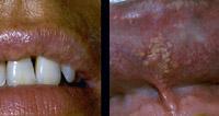 Fordyce glands on inner aspect of upper lip.