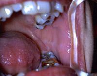 Retraction of the cheek to view the buccal mucosa which includes the papilla of Stensen duct opposite