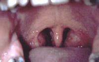 Enlarged palatine tonsils with some crypts.showing at the surface Tonsillar crypts are indentations that can become filled with bacteria.