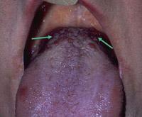 3- The circumvallate papillae, the largest of the papillae, are present in the most posterior part of the tongue as two rows of structures forming an upside down "V", with pointing toward the throat.