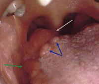 An enlarged lingual tonsil, Grey arrow.