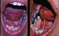 Next, have the patient open the mouth and try to touch the hard palate with the tongue.