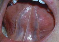 Normal ventral surface of the tongue showing the midline lingual frenum, and the two