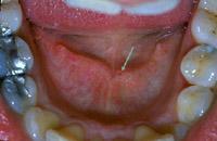 Normal floor of the mouth showing bilateral sublingual plicae or carunculae. At the medial aspect of each is the opening of Wharton duct, green arrow.