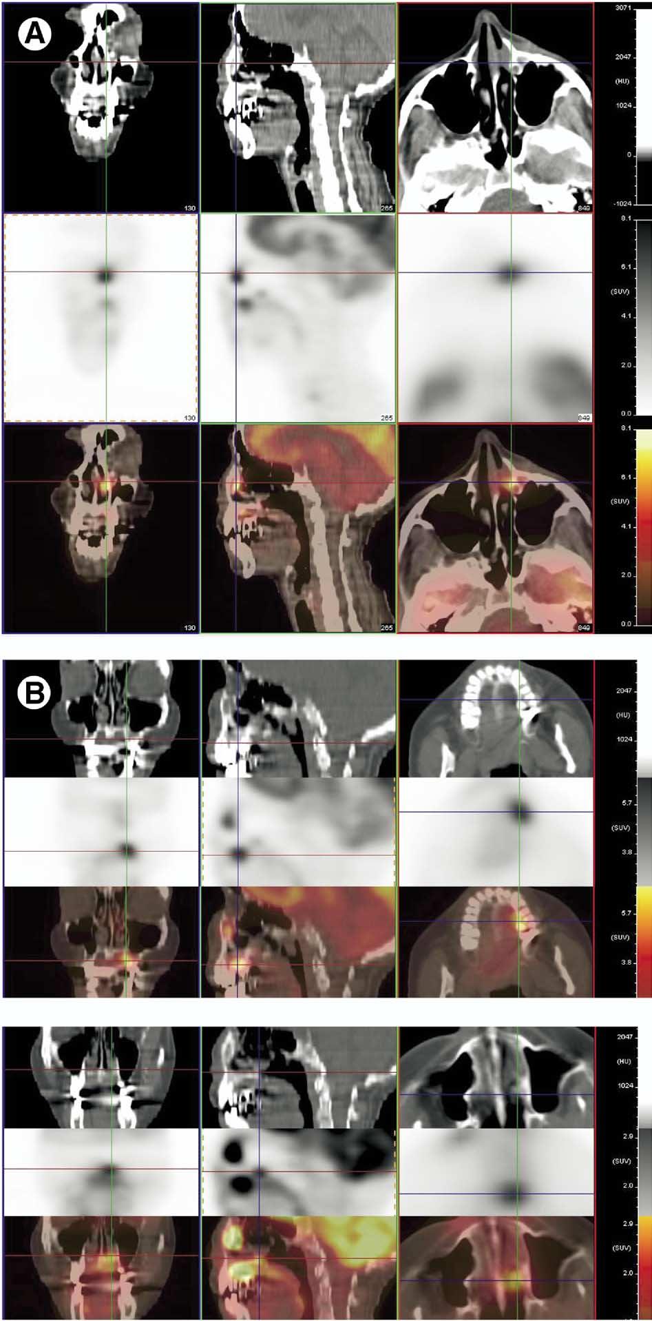 PET-CT Imaging of head and neck tumors: An atlas 229 Figure 9 (A) Squamous cell carcinoma of the nasolacrimal duct. These cancers present relatively early because of obstruction of the lacrimal duct.