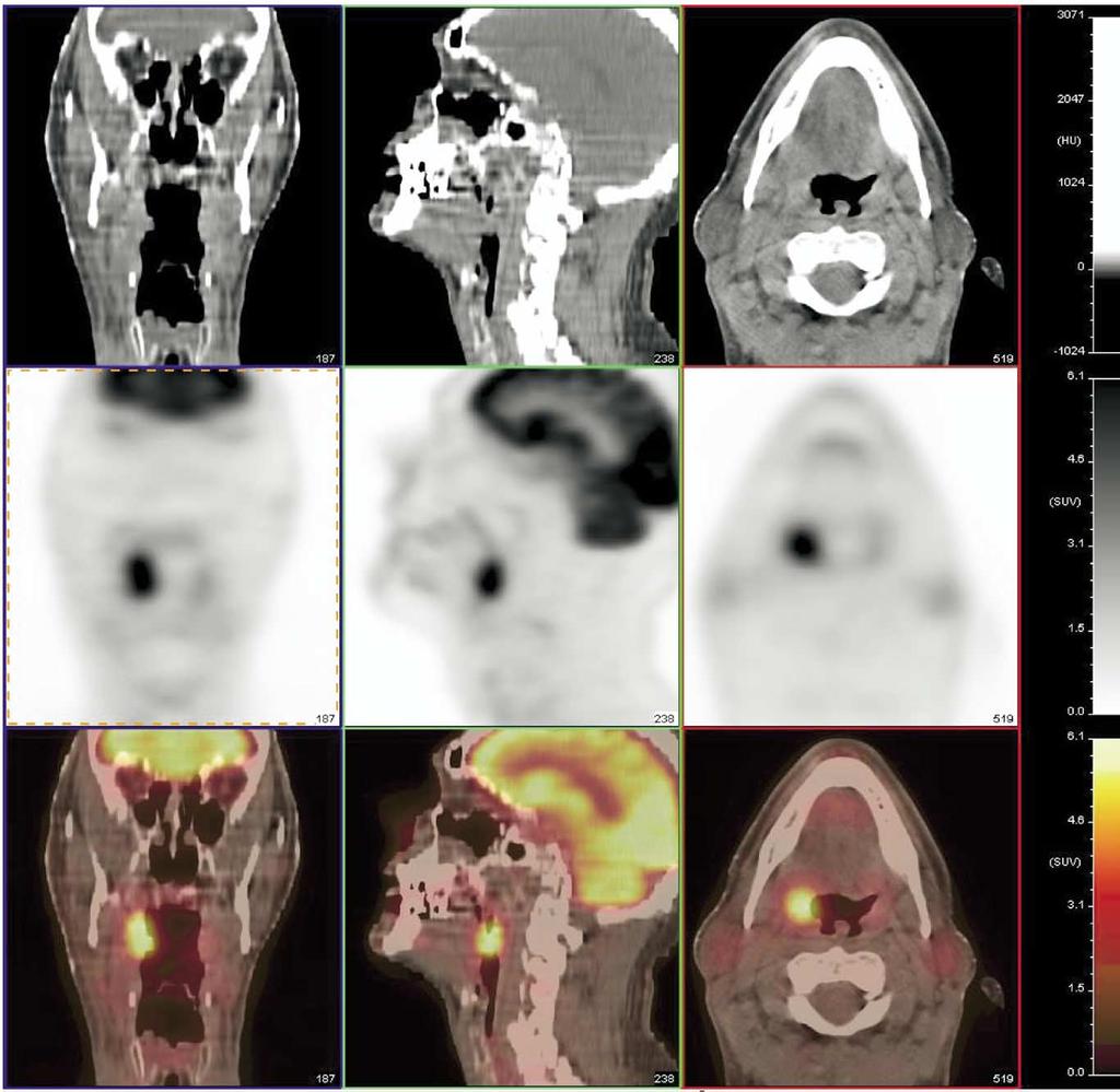 PET-CT Imaging of head and neck tumors: An atlas 231 Squamous Cell Carcinoma of the Tonsils Figure 11 Right tonsillar squamous cell carcinoma.