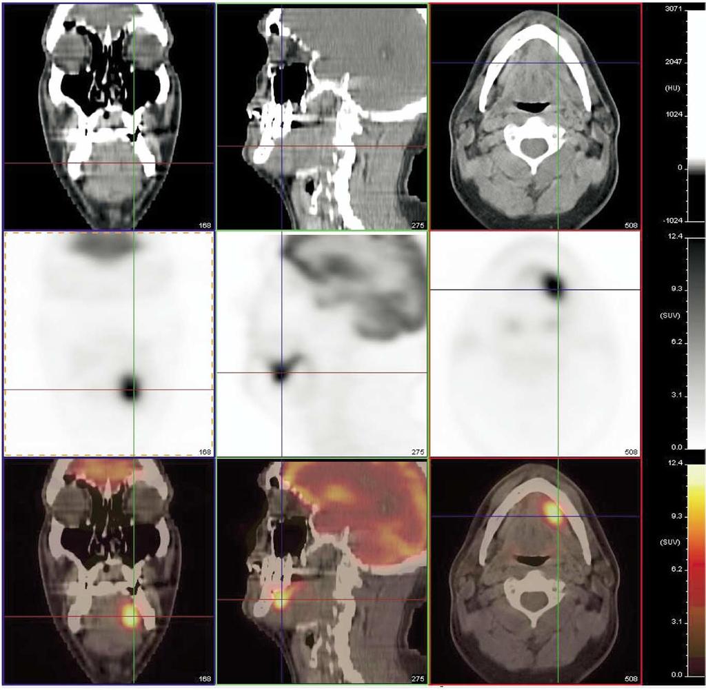 PET-CT Imaging of head and neck tumors: An atlas 235 Figure 15 Squamous cell carcinoma of the left floor of the mouth, the region immediately