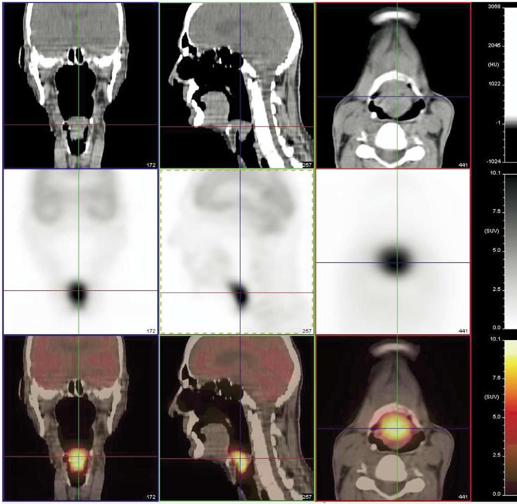 PET-CT Imaging of head and neck tumors: An atlas 237 Squamous Cell Carcinoma of the Hypopharynx, Including Epiglottis, Piriform Sinus Figure 17 Squamous cell carcinoma of the epiglottis.