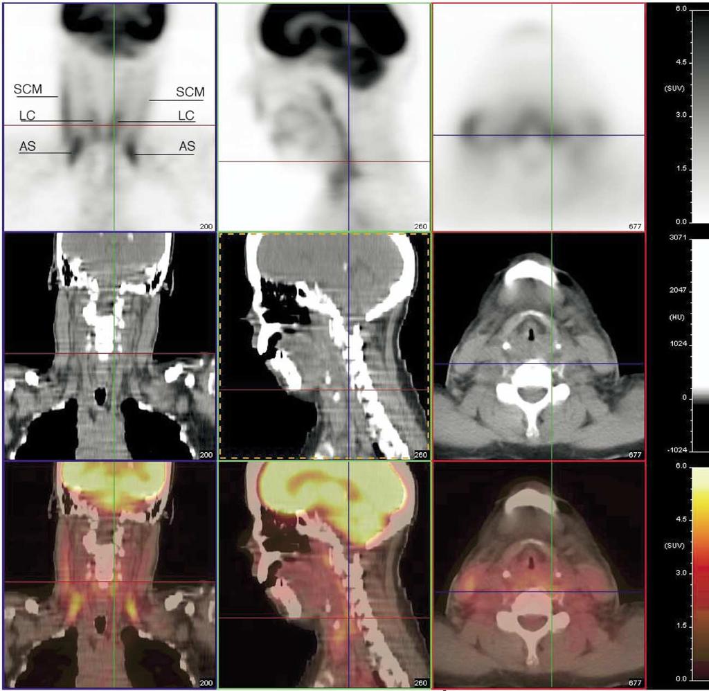 PET-CT Imaging of head and neck tumors: An atlas 221 Appearance of Normal Structures Figure 1 Normal uptake in sternocleidomastoid (SCM), longus coli (LC), and anterior scalene (AS) muscles.