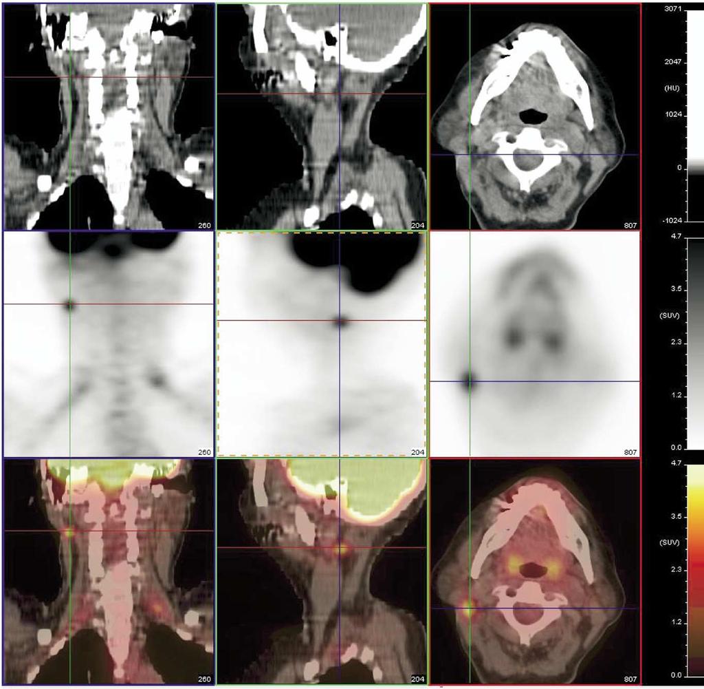 PET-CT Imaging of head and neck tumors: An atlas 247 Figure 27 Level IIB node. It is located considerably more posterior than the IIA node seen in Figure 26.