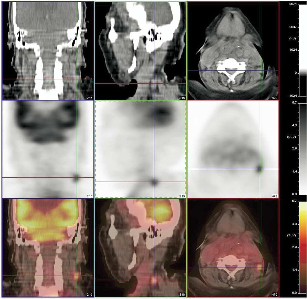 PET-CT Imaging of head and neck tumors: An atlas 251 Figure 31 VA lymph node.