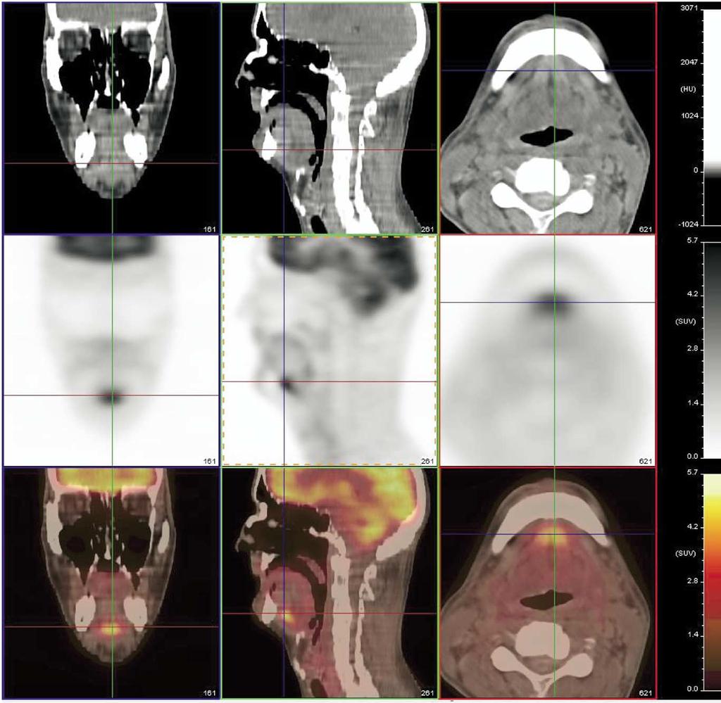 PET-CT Imaging of head and neck tumors: An atlas 223 Figure 3 Normal uptake in the floor of the mouth, involving the anterior aspect of the genioglossus muscle, which is the