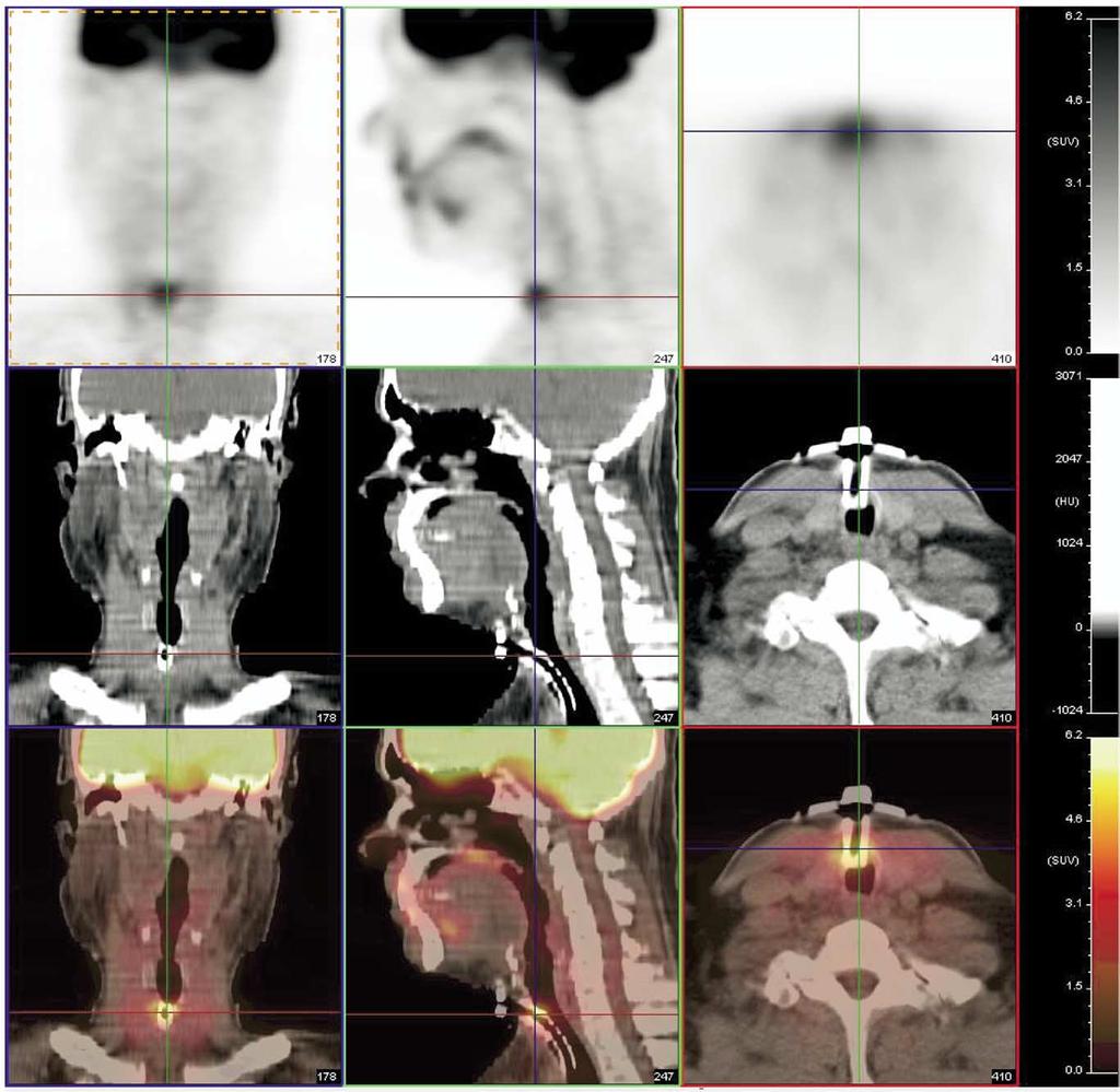 PET-CT Imaging of head and neck tumors: An atlas 225 Figure 5 Normal uptake in a tracheostomy site.