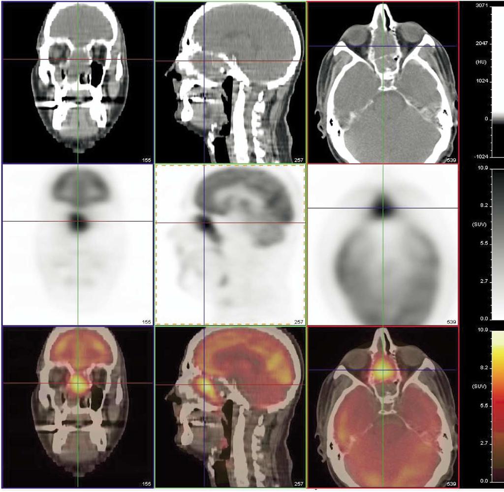 PET-CT Imaging of head and neck tumors: An atlas 227 Sino-Nasal Malignancies Figure 7 A poorly differentiated squamous cell carcinoma of the ethmoid sinuses.