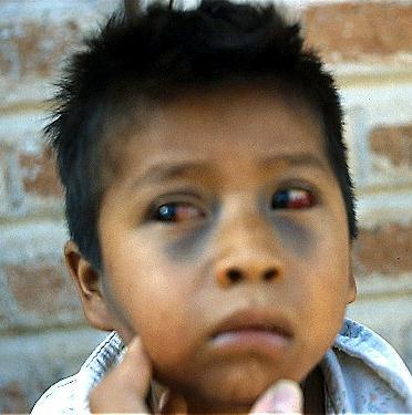 Pertussis Disease Manifestations Child with subconjunctival hemorrhages and facial ecchymoses due to pertussis coughing.