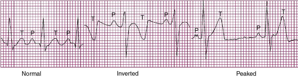 Abnormal T Waves The T wave following an abnormal QRS