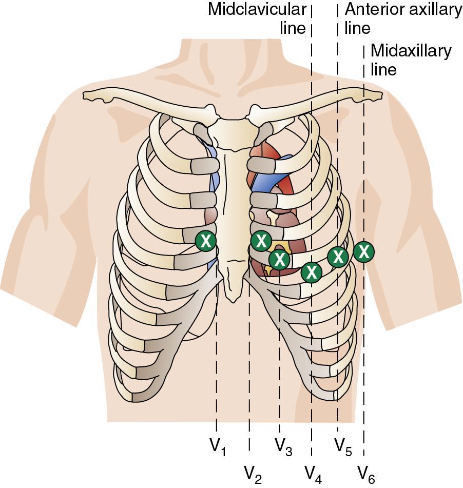 Horizontal Plane Leads Six chest (precordial or V ) leads view