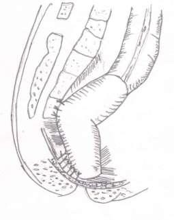 way to the anus. This incision is deepened to expose the coccyx, which is then removed. The retrorectal space is entered by blunt dissection. The levator muscle is divided in the midline.